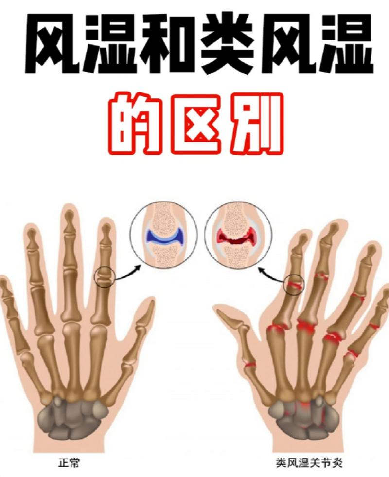 类风湿和风湿是一样吗