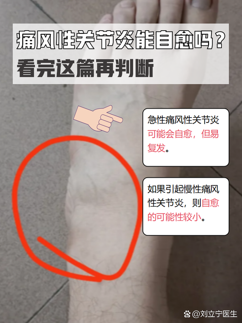 风湿性关节炎风湿小节