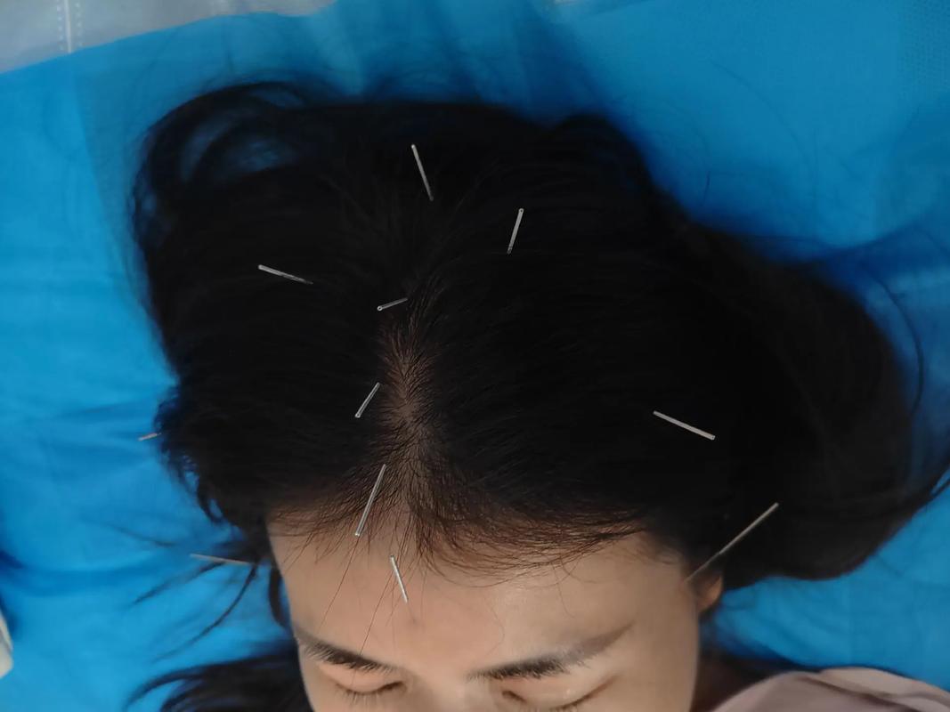 右侧头疼 针灸穴位