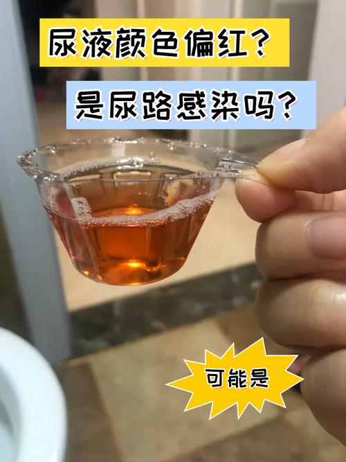 卧床脑梗老人尿液发红