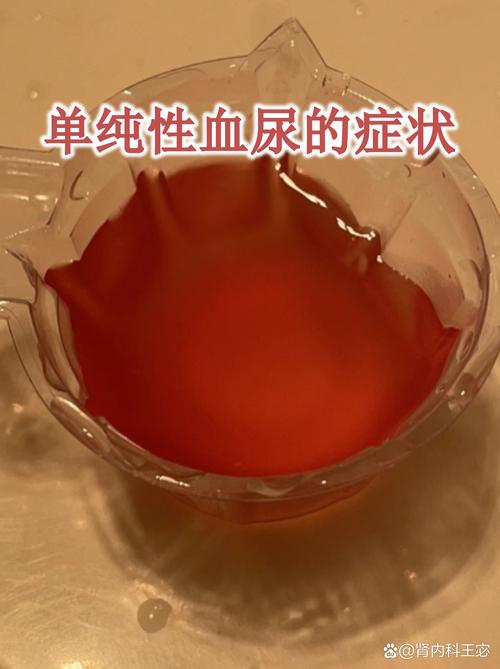 卧床脑梗老人尿液发红