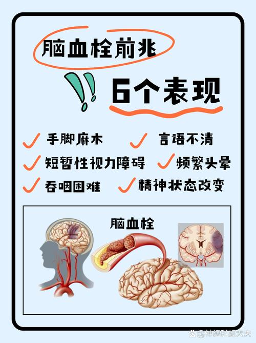 预防脑梗如何清除淤血