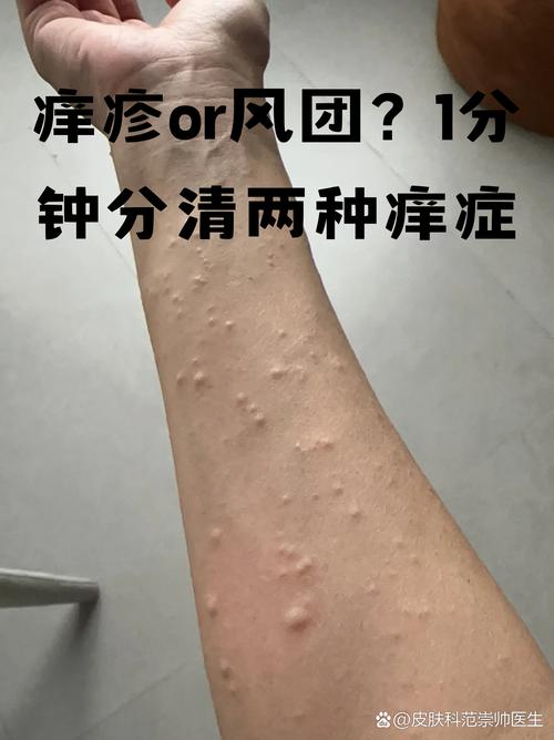 风湿性荨麻疹是风湿吗