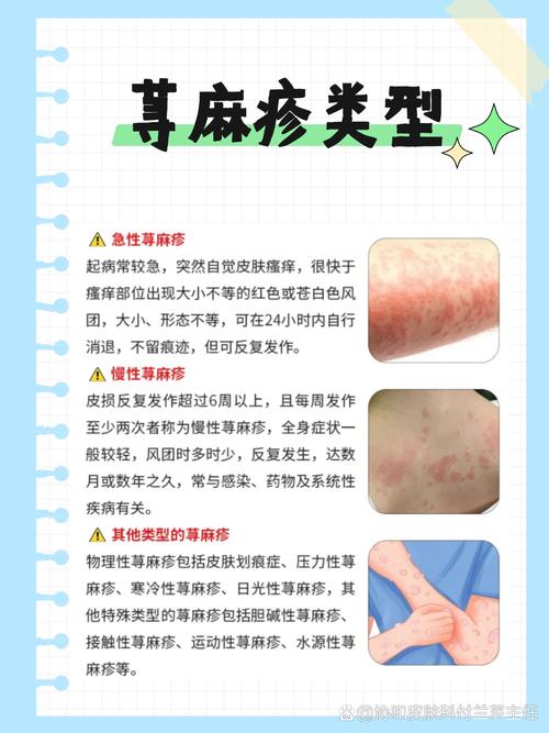 风湿性荨麻疹是风湿吗