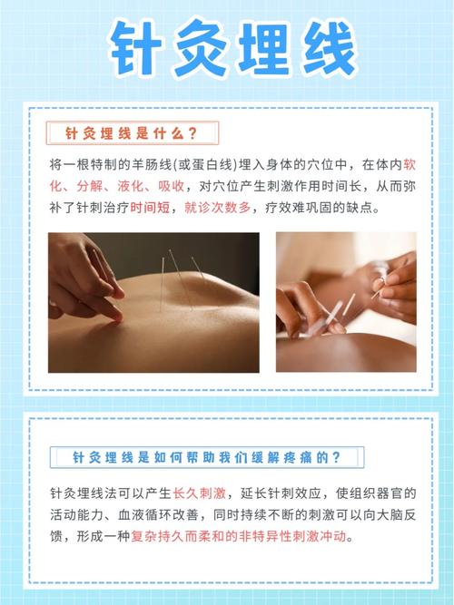 穴位埋线最多几个穴位