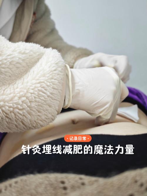 穴位埋线最多几个穴位