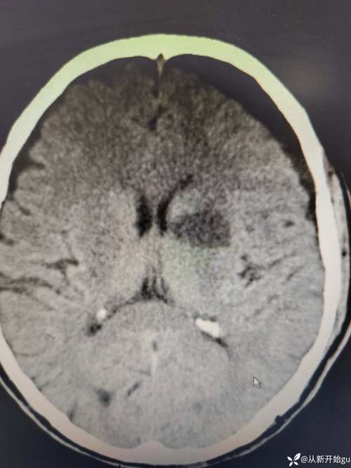 大面积脑梗脑沟裂消失