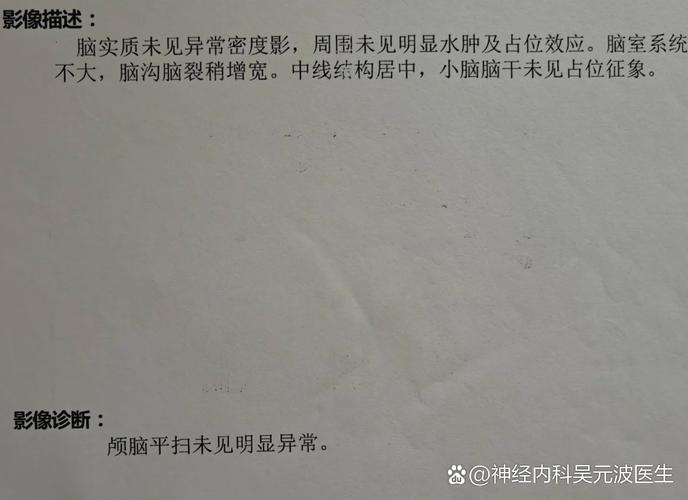 大面积脑梗脑沟裂消失