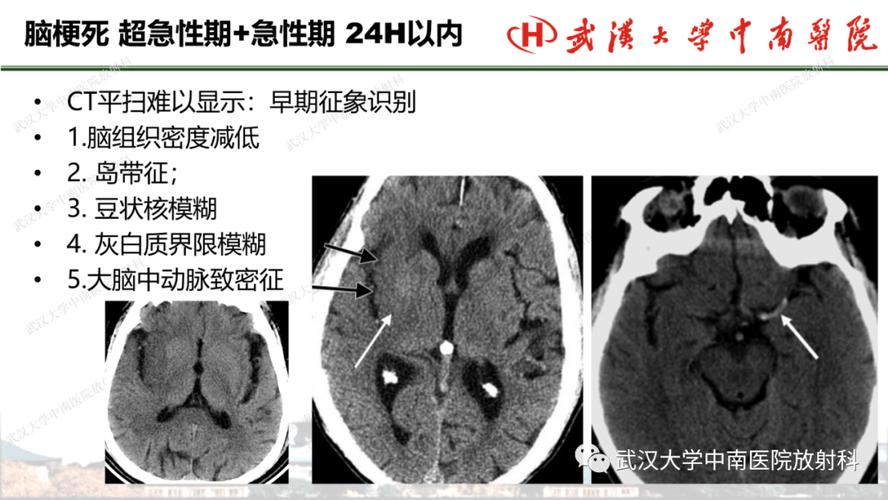 脑ct能看出来脑梗吗