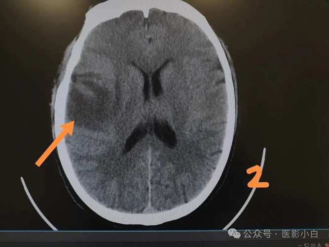 脑ct能看出来脑梗吗