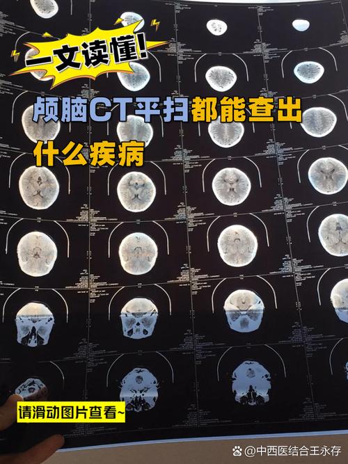 脑ct能看出来脑梗吗