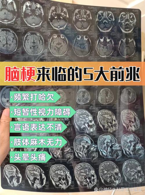 间隙性脑梗是脑血拴吗