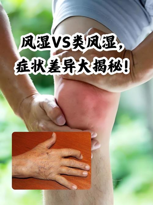 风湿会转变成类风湿么