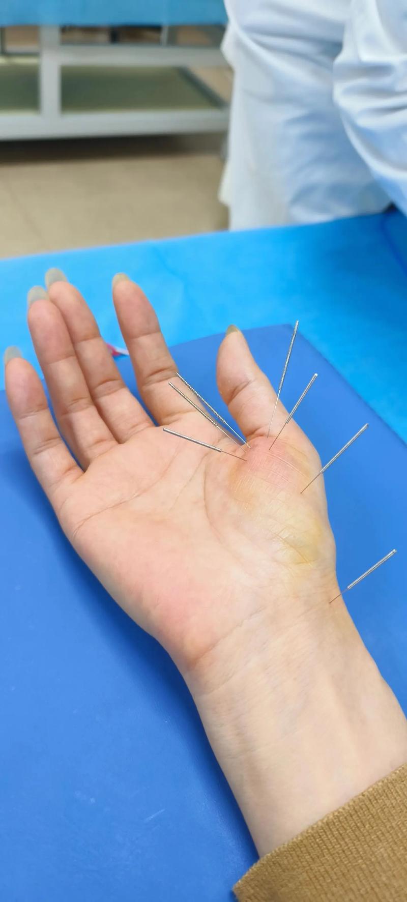 大拇指腱鞘炎艾灸穴位