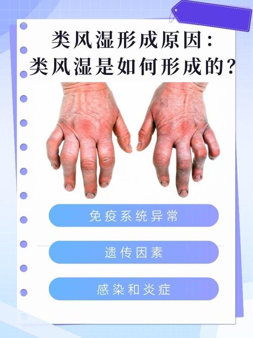 风湿热型类风湿的治疗