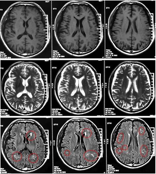 脑系核磁脑内少许腔梗