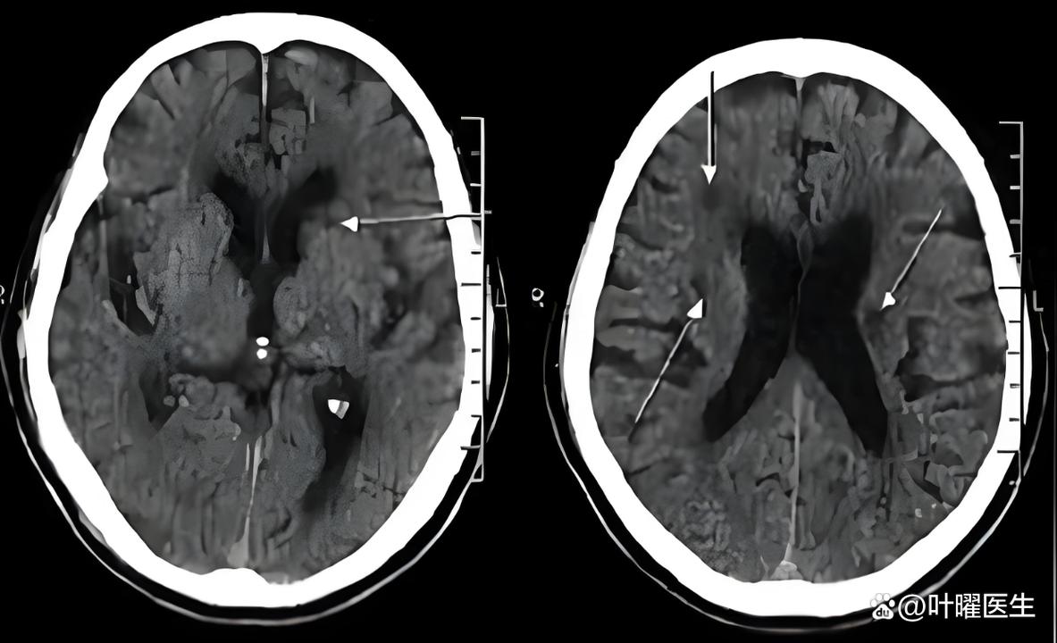 脑系核磁脑内少许腔梗
