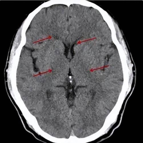 脑系核磁脑内少许腔梗