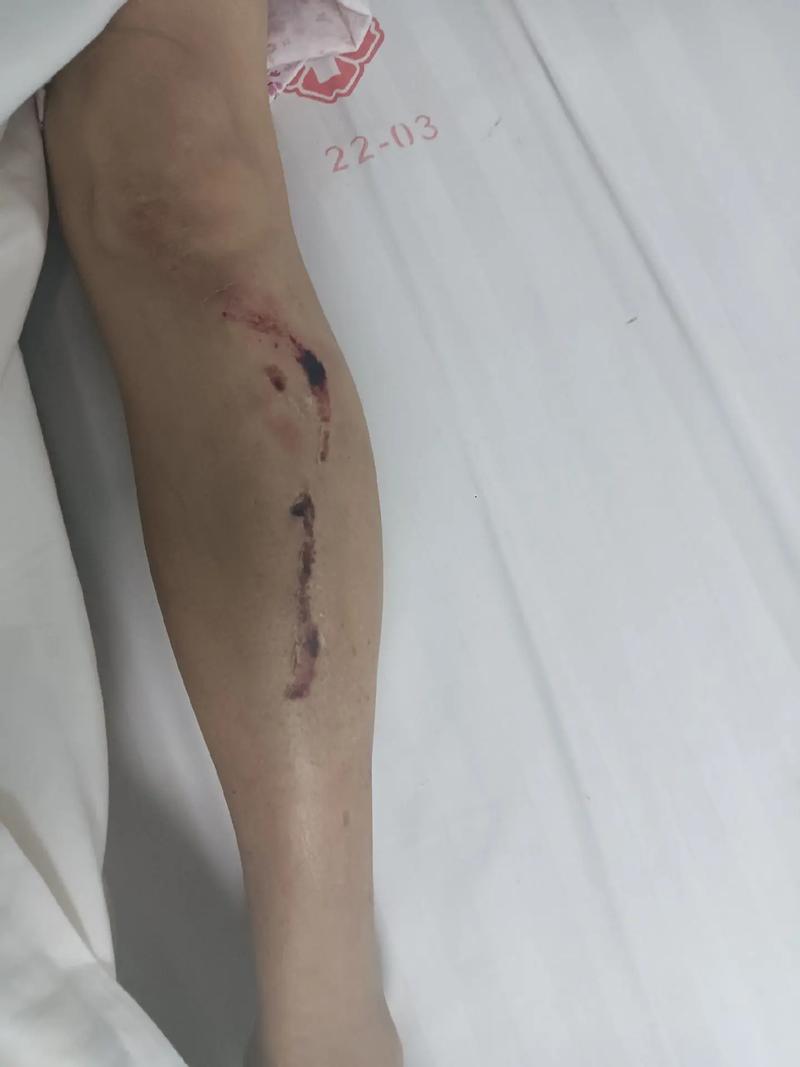 脑挫裂伤会引发脑梗吗