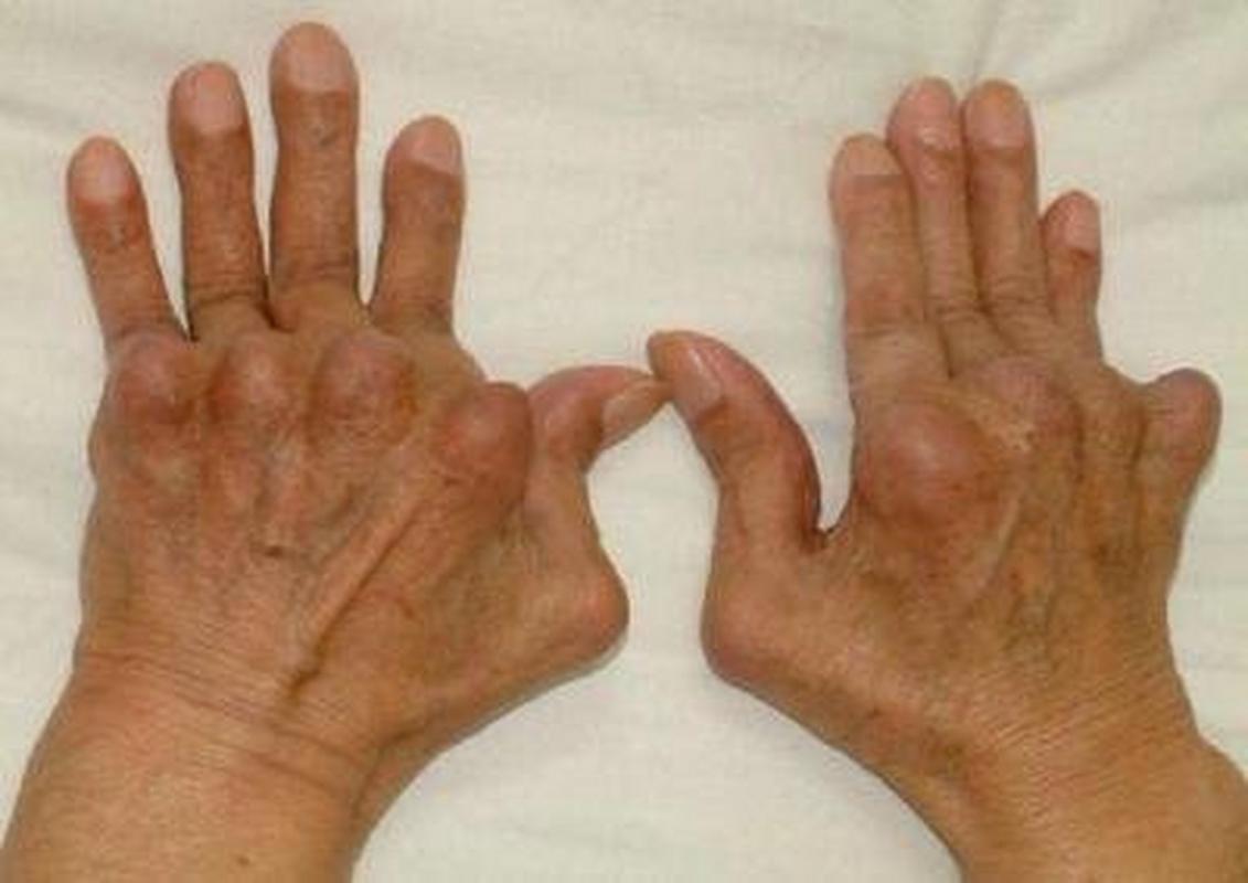 游走性风湿是类风湿吗