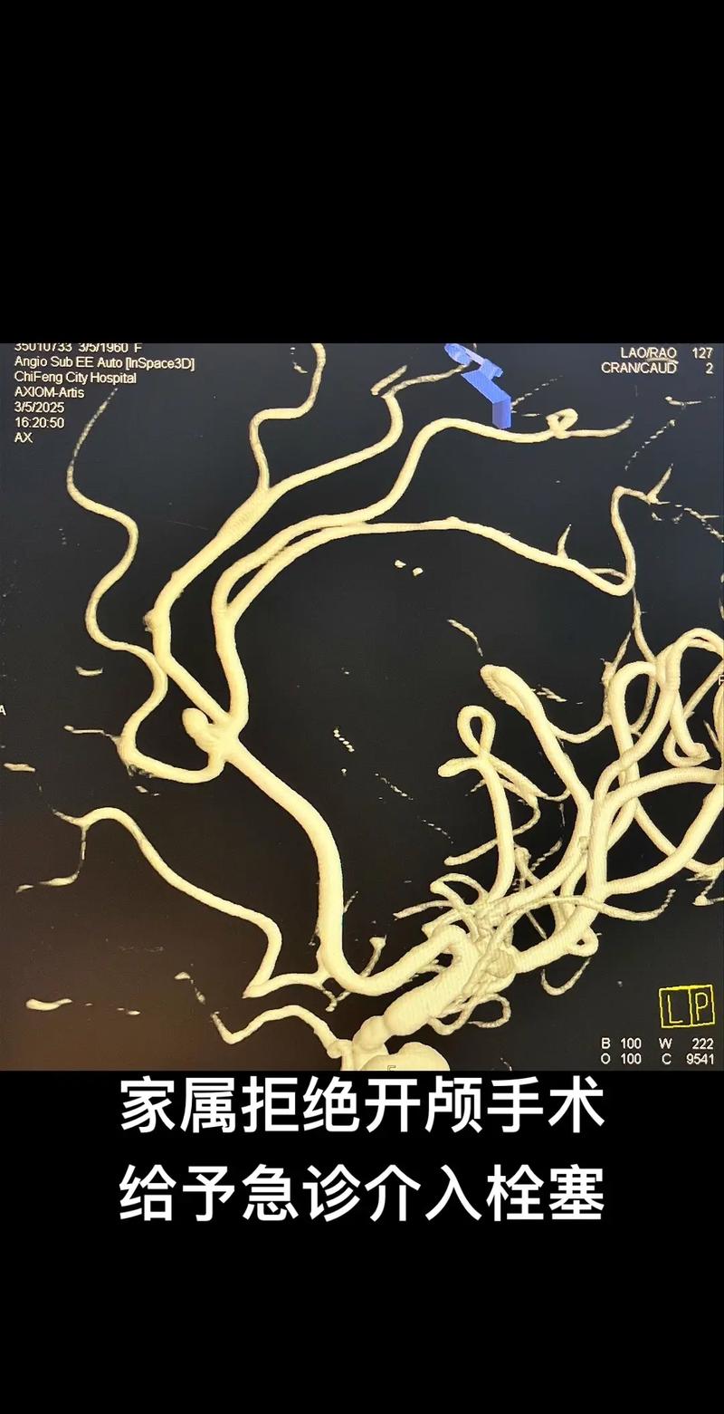 脑梗和脑动脉瘤的区别