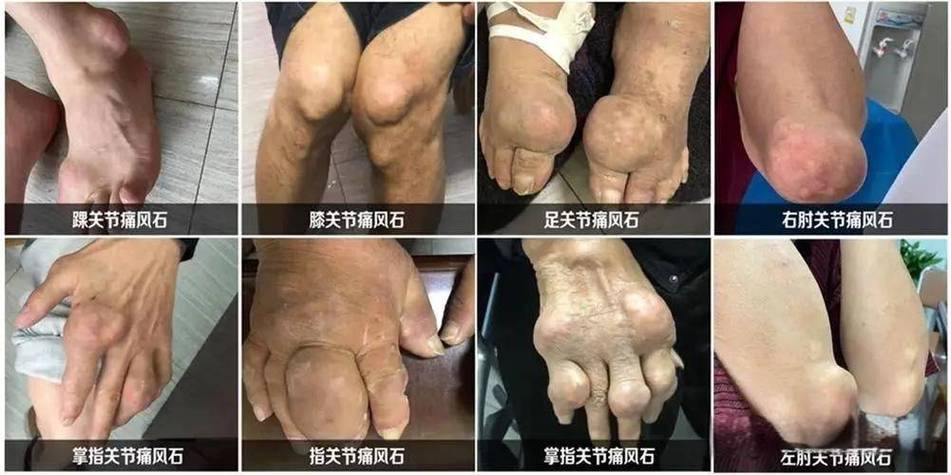 内风湿可以吃痛风湿片