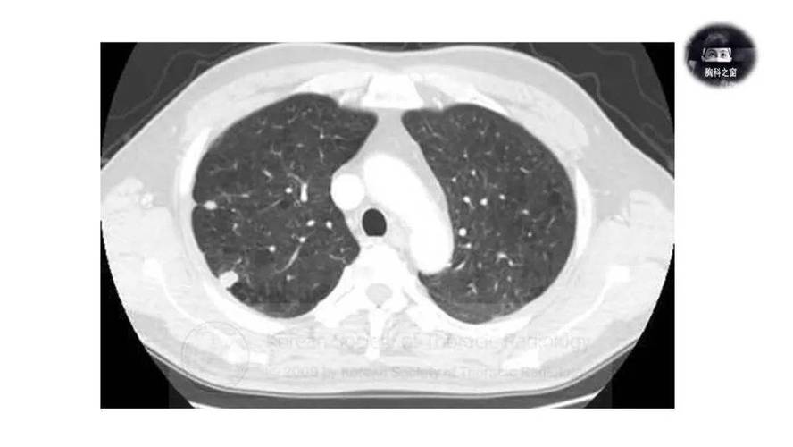 类风湿肺部类风湿结节