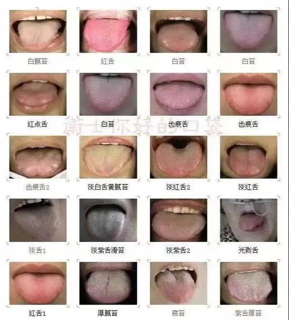 脑梗患者可吃安脑丸吗