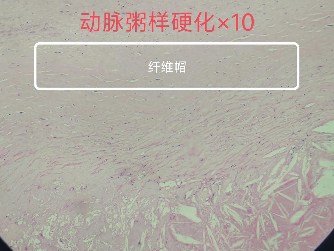 风湿巨细胞与风湿小体