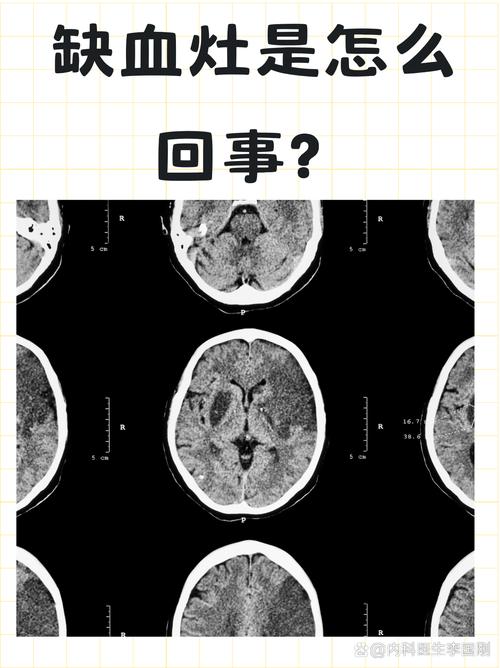 脑点状缺血灶是脑梗吗