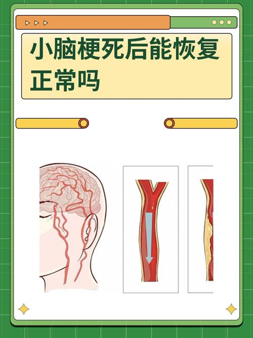 脑小血管病变是脑梗吗