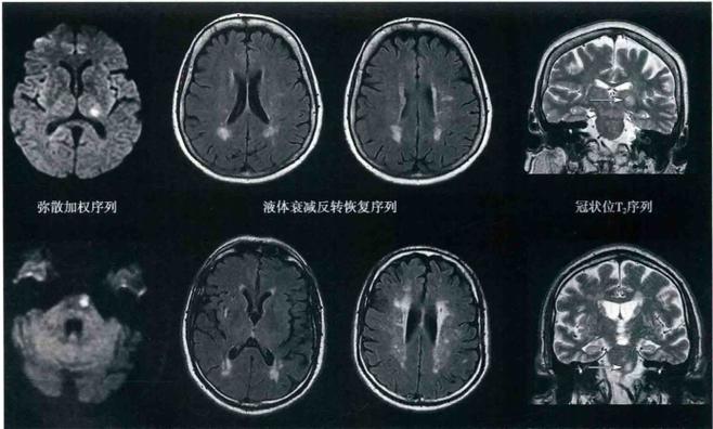 桥脑腔隙性脑梗痊愈了
