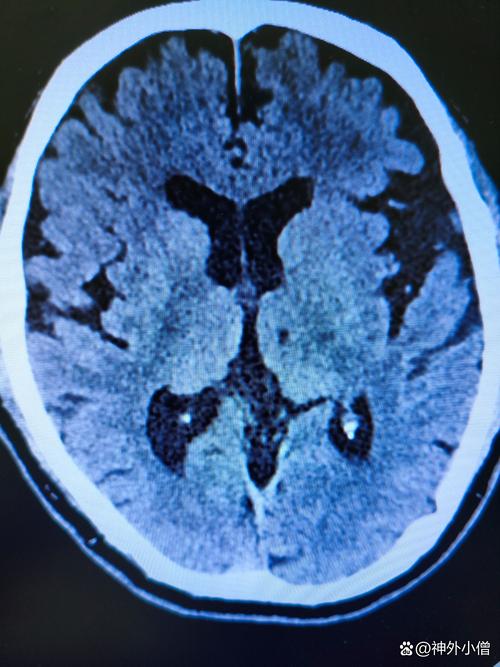 桥脑腔隙性脑梗痊愈了