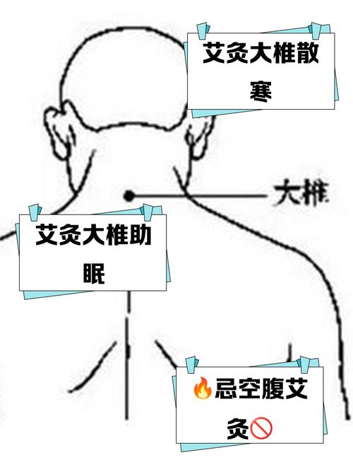 强直性脊柱炎艾灸穴位