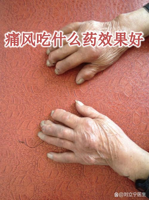 类风湿吃了风湿痛风灵