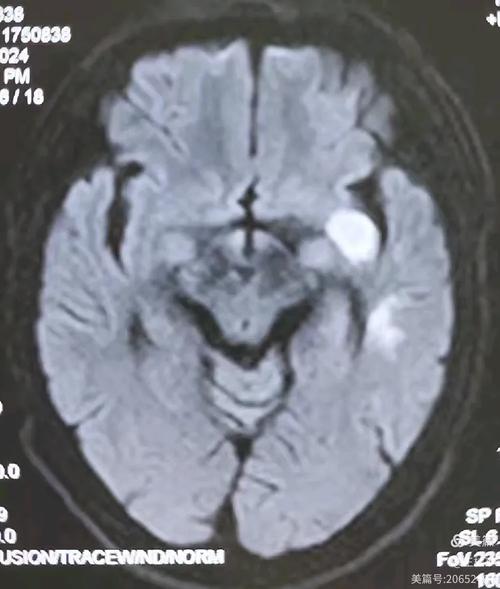脑彩超正常会是脑梗吗