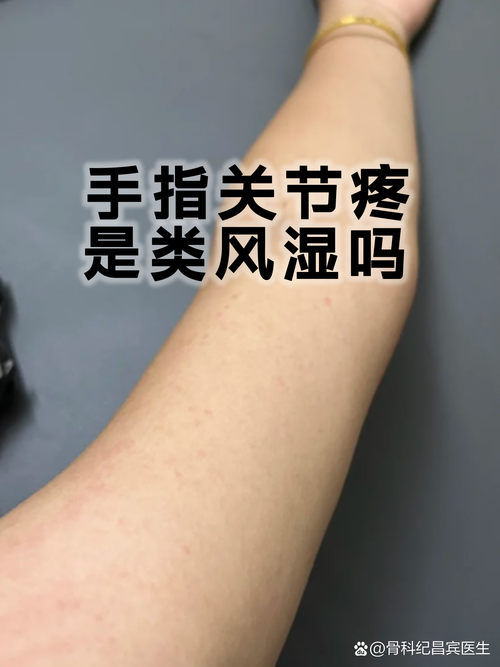 风湿八项是风湿全套吗