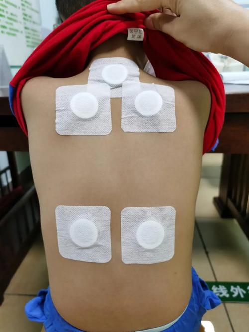 益苼堂穴位贴敷治疗贴