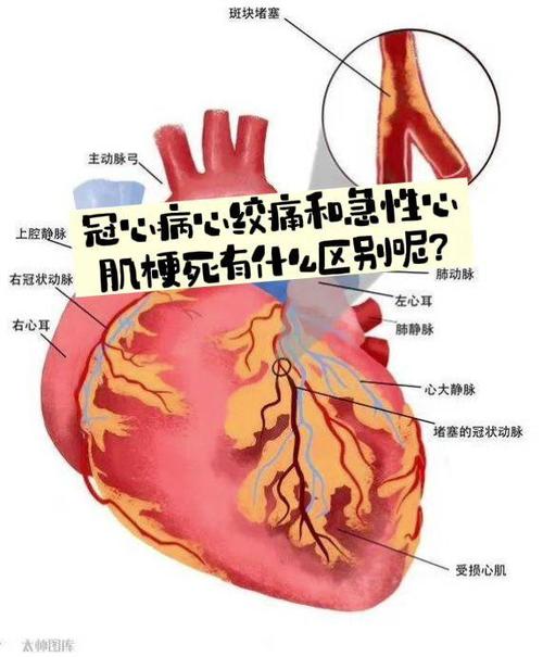为什么会得心梗和脑梗