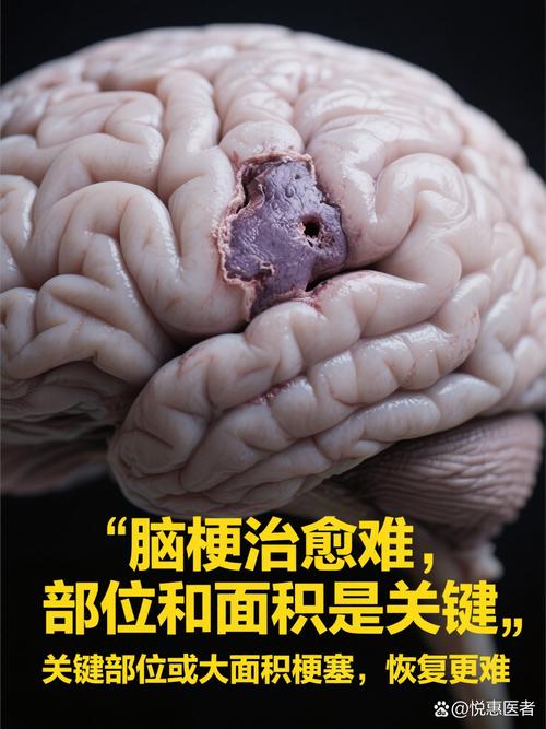 脑梗脑积液可以足疗吗
