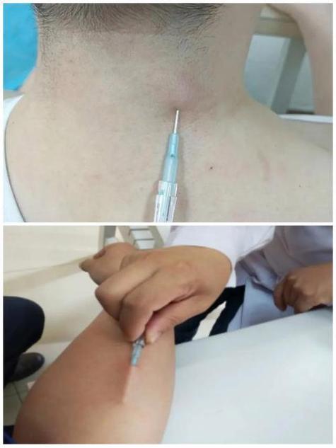 穴位注射法治疗颈椎病