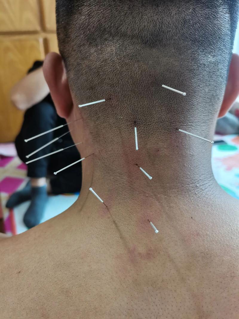 穴位注射法治疗颈椎病