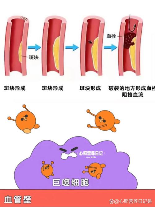 脑梗合并心梗抗血小板