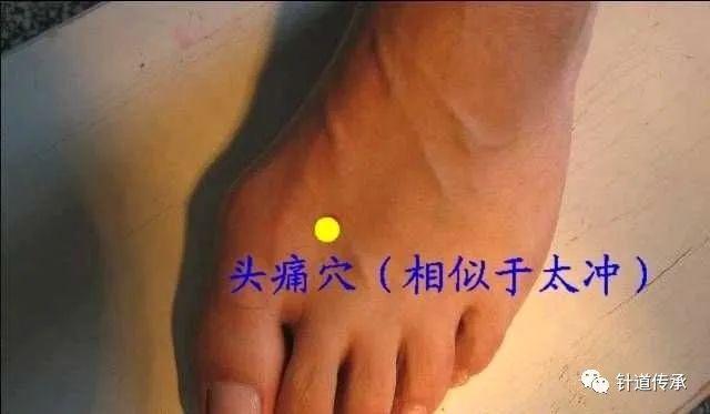 王文远平衡针灸穴位图