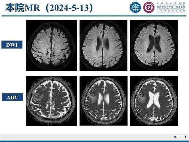 脑梗做Mri dwi