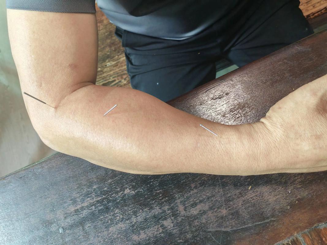 肱骨外上髁炎针灸穴位