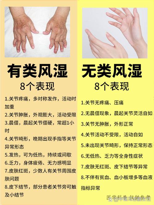 风湿类风湿只会对称么