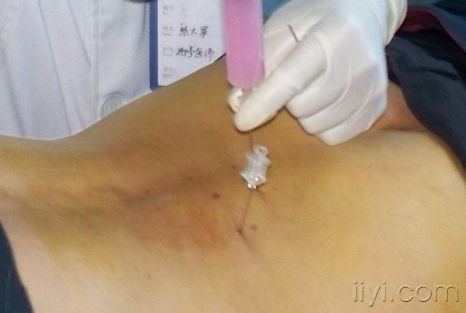 南阳风湿类风湿水针刀