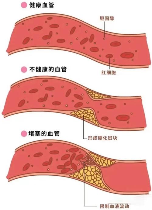 血管细容易心梗脑梗吗