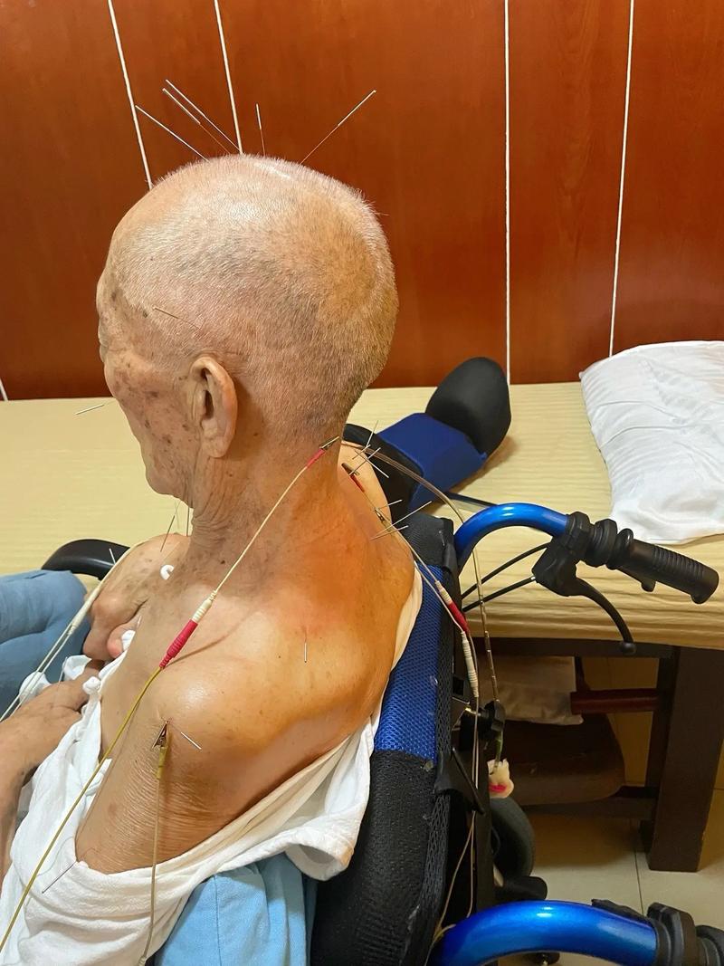 脑梗 半年 针灸有效